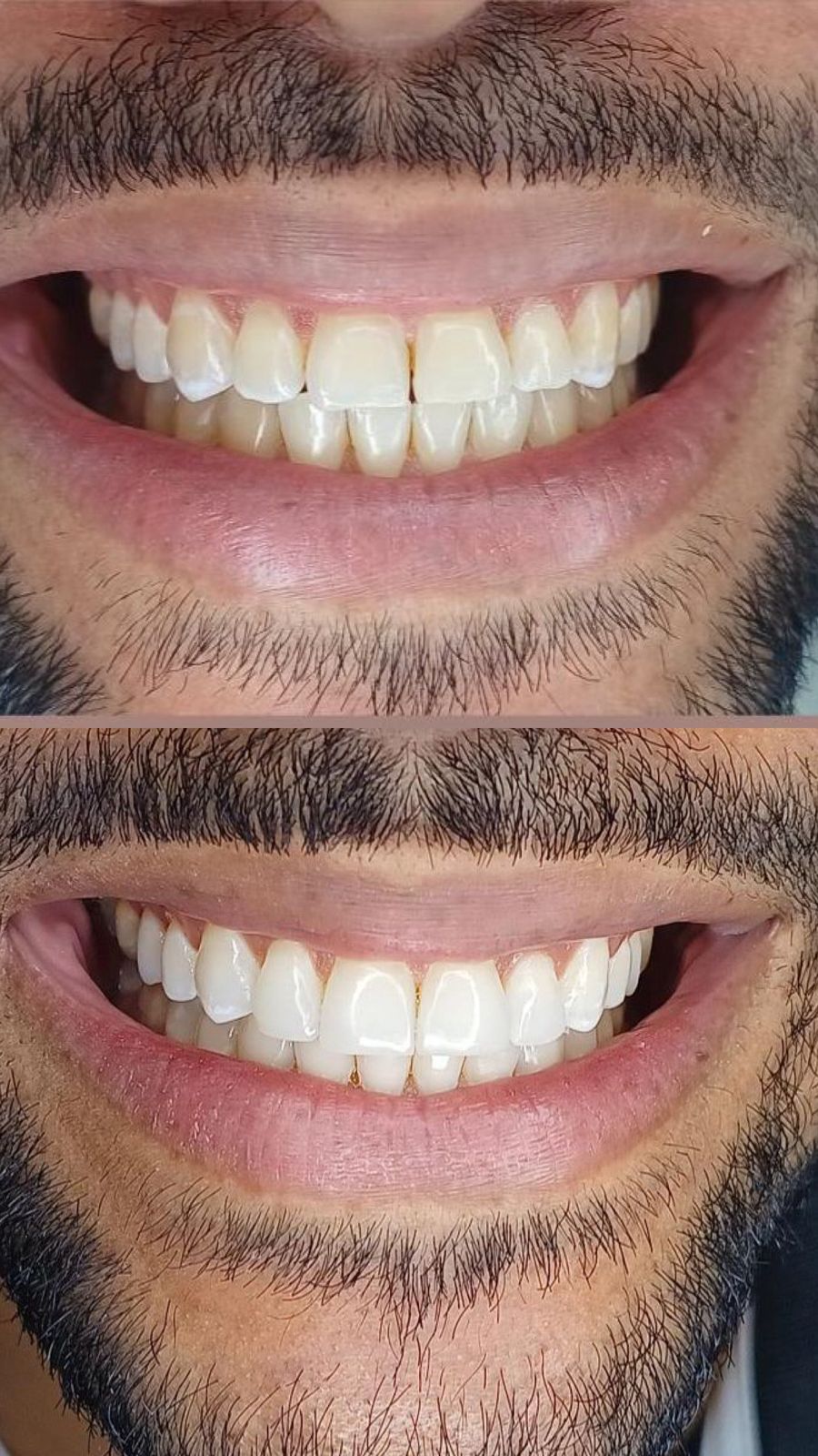 Antes e depois — Clareamento e Acréscimos em Resina