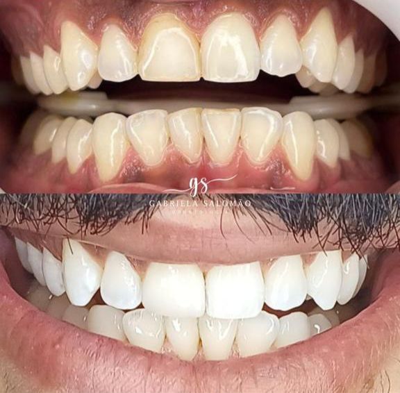Antes e depois — Clareamento e Lente em Porcelana