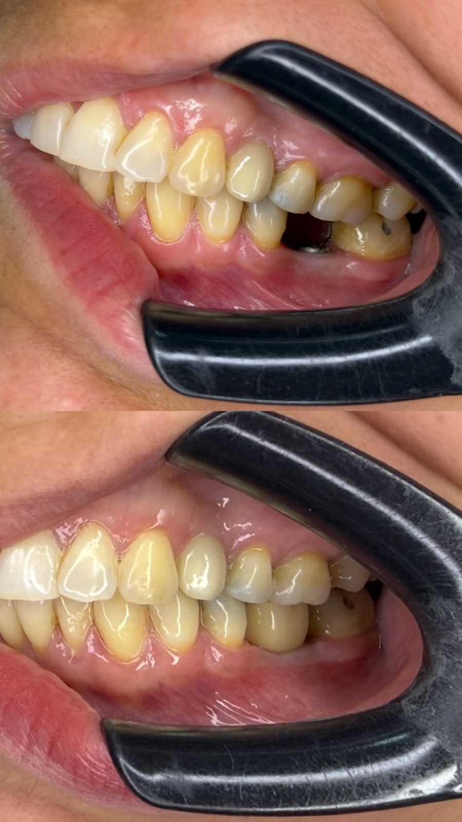 Antes e depois — Implante Unitário