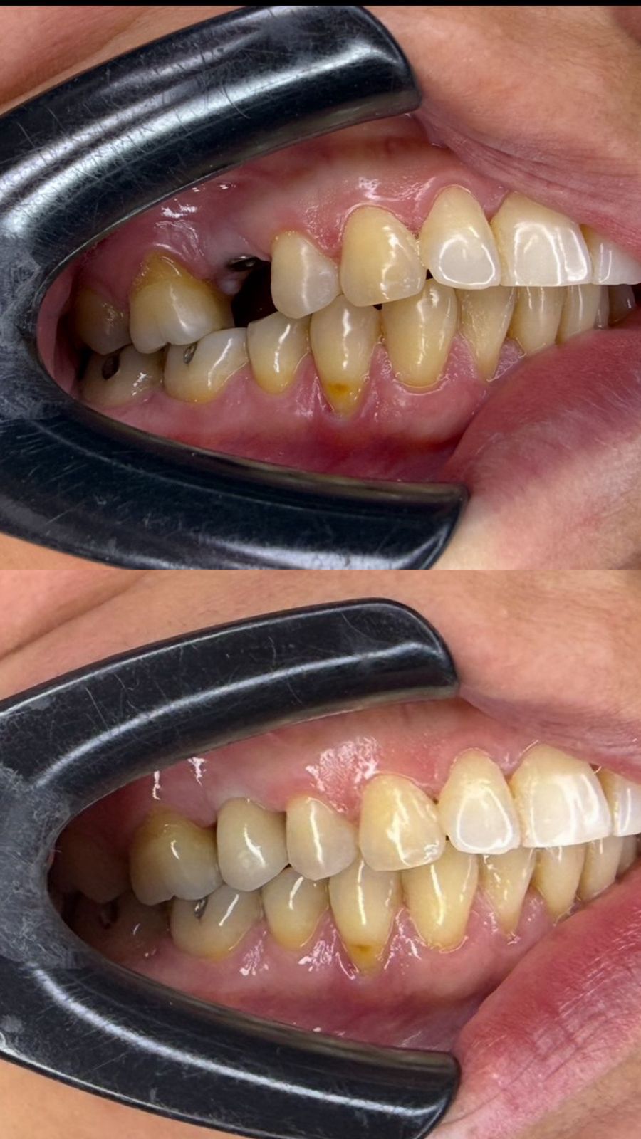 Antes e depois — Implante Unitário