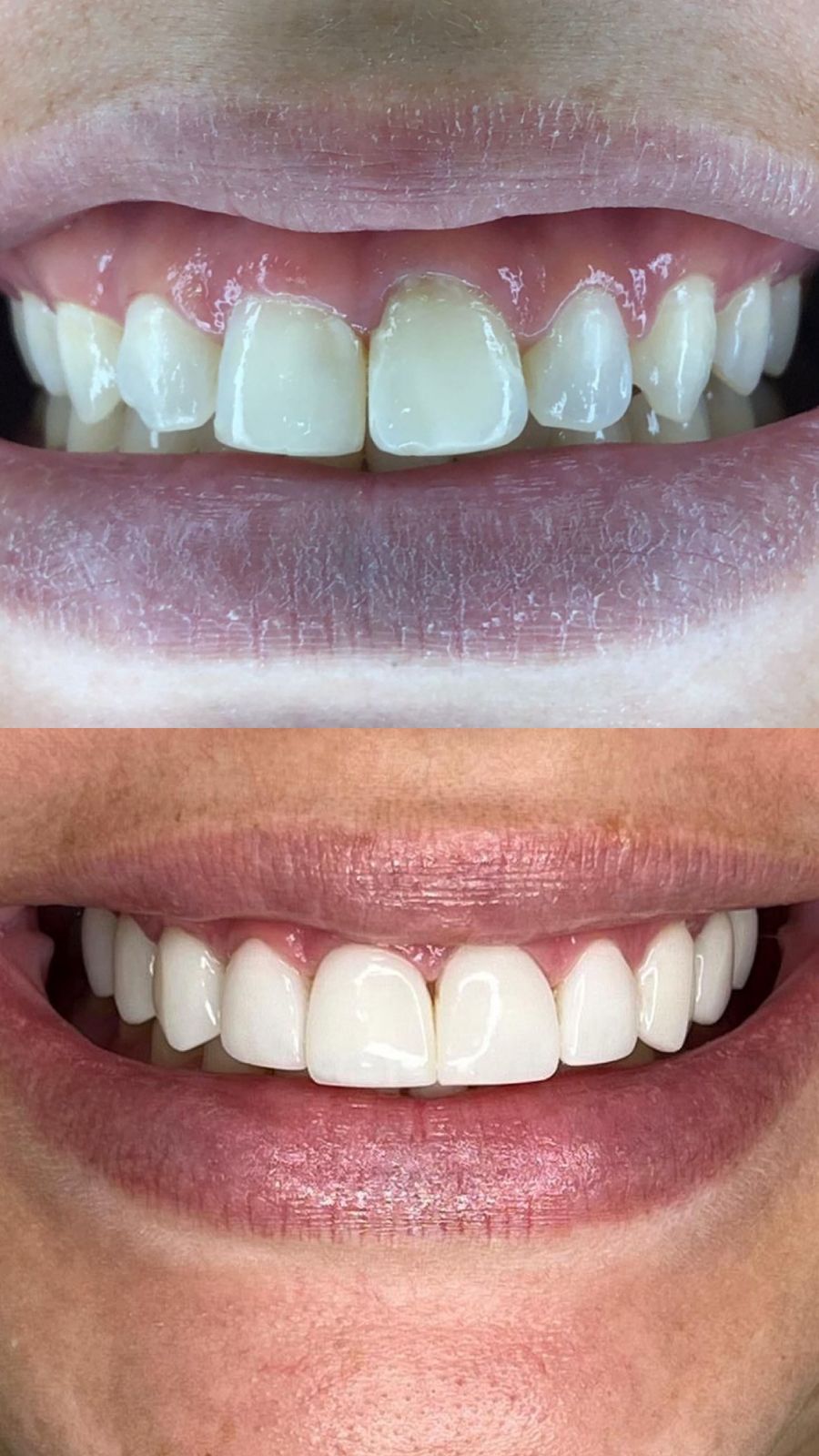 Antes e depois — Lentes em Resina Superior