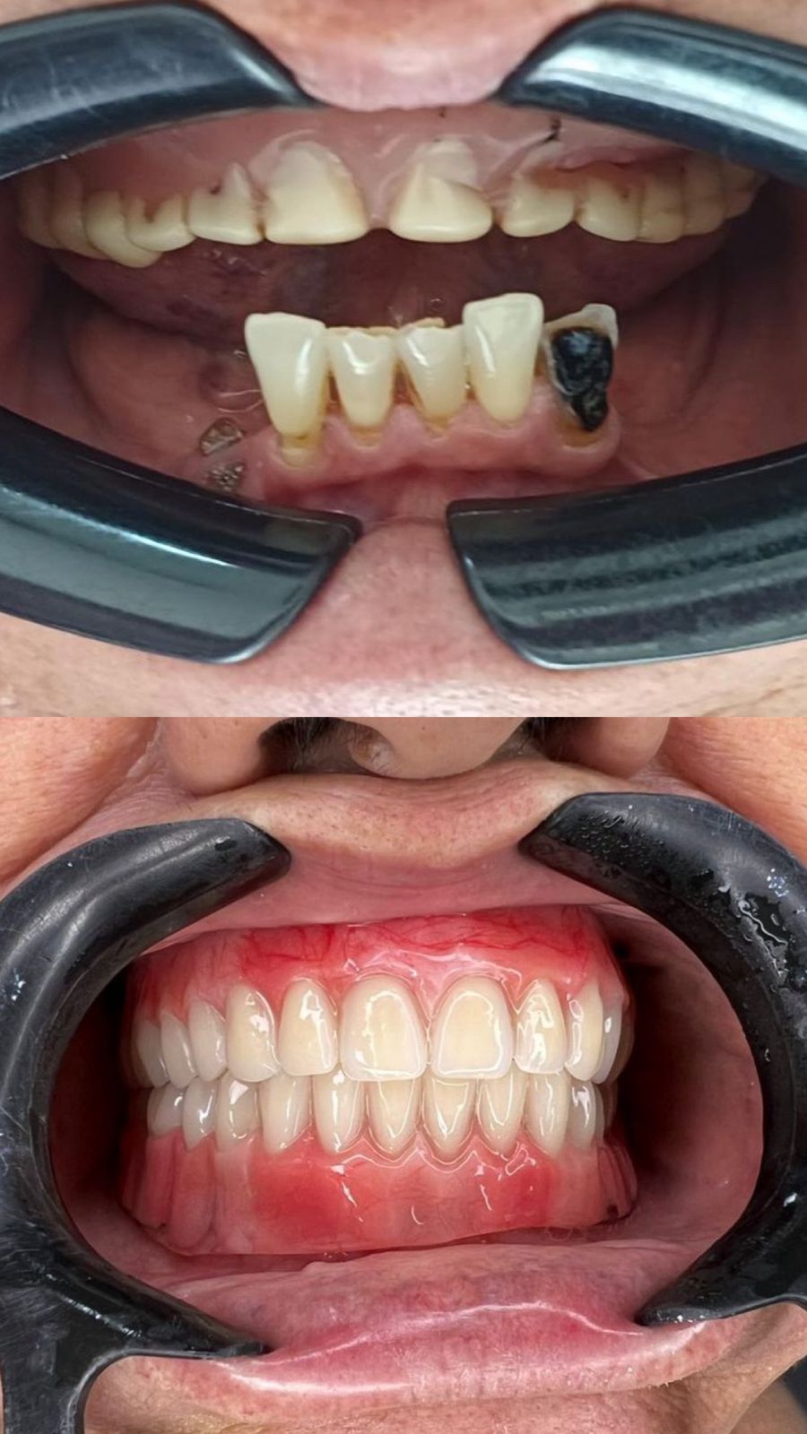 Antes e depois — Prótese Total Superior e Overdenture Inferior