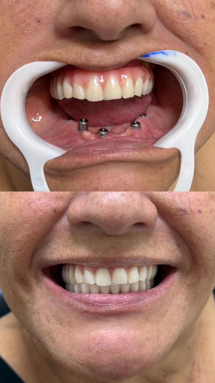 Antes e depois — Protocolo Inferior sobre Implantes