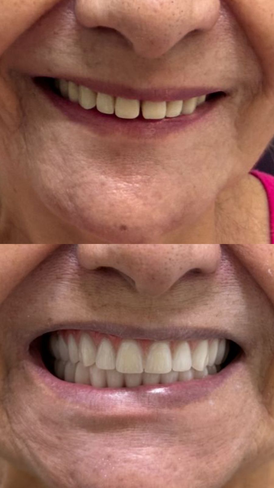 Antes e depois — Protocolo Superior